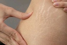 5 Cara Mencegah Munculnya Stretch Mark yang Wajib Kamu Tahu, Berikut Penjelasannya